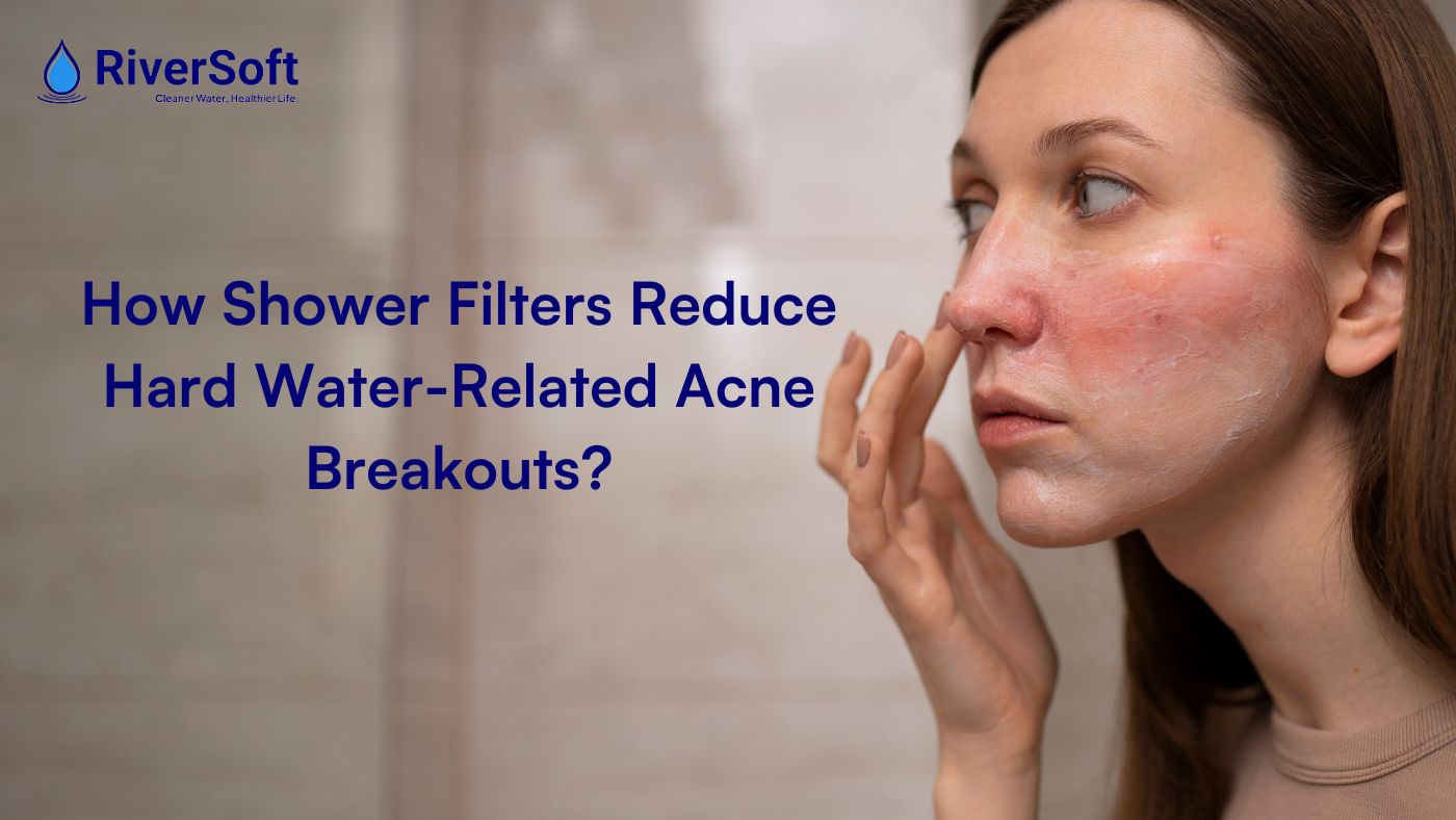 Does Hard Water Cause Acne? How Shower Filters Help in 2026